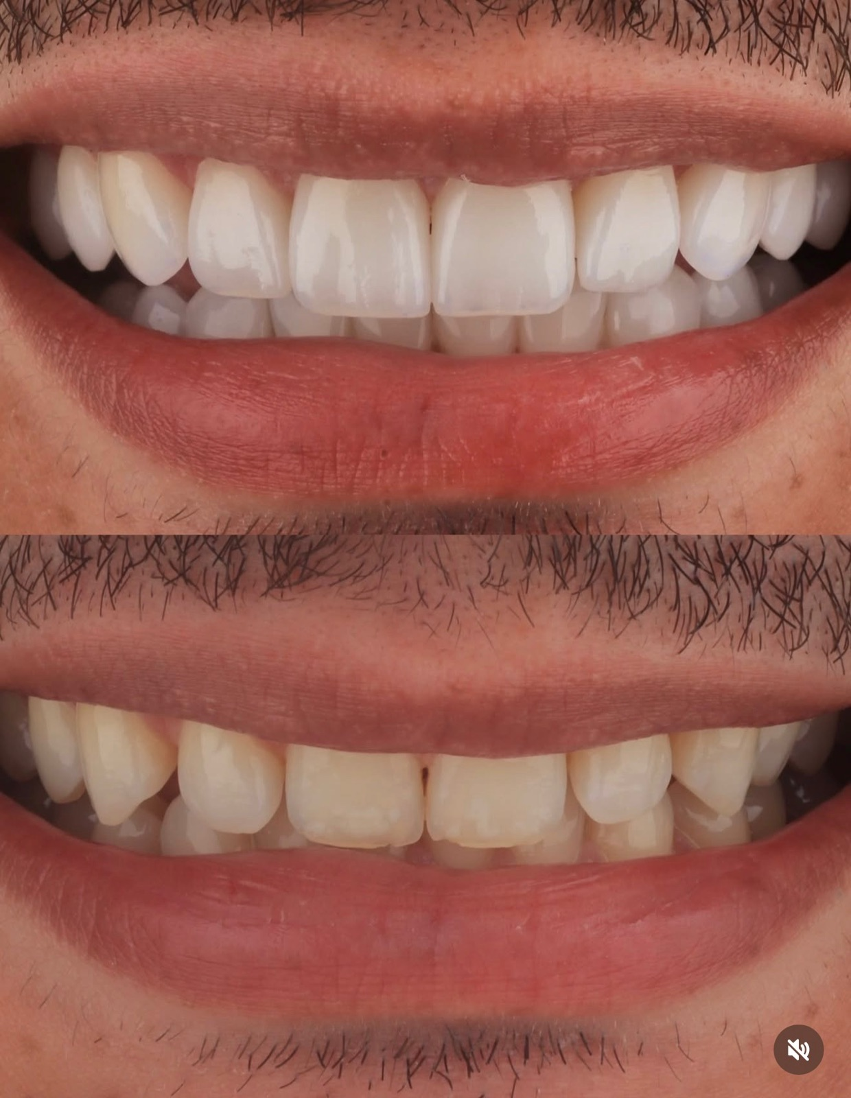 Antes y después de un diseño de sonrisa