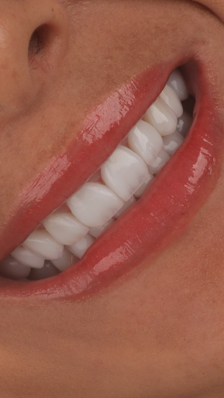 Sonrisa después de tratamiento estético
